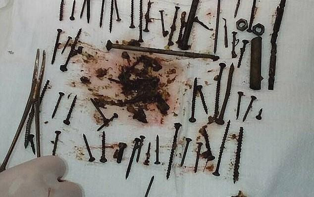 Είχε αναιμία: Κατάπιε 152 καρφιά και μπουλόνια για να αυξήσει τον «σίδηρο» στο αίμα της -Έμειναν… οι γιατροί (εικόνα)